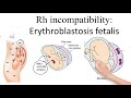 rh incompatibility ii erythroblastosis fetalis ii prevention with rhogam