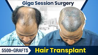 Giga Session Hair Transplant in Pune | Hair Transplant Results \u0026 Cost in Pune #hairtransplant