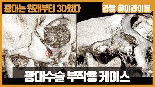 광대수술후 부작용 발생 실사례 및 해결방법 [광대는 원래부터 3D였다 #3]