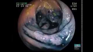 Macroscopic Features of Submucosal Invasion in Colorectal Lesions