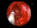 Sinus surgery: Total Ethmoidectomy