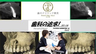 No.4002 歯を抜かない！外科的延出＆歯根端切除術Ｃａｓｅ１　歯のクリニック東京　顕微鏡　マイクロスコープ　歯科自費