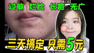 【祛痘】过敏初期到底咋做？N家医院总结，不超50￥敏感瘙痒实战经验！