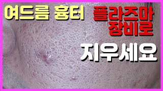 여드름 흉터의 가장 많은 타입인 Icepick scar 에 플라즈마 장비를 활용해서 매우 좋은 결과를 얻고 있습니다. 흉터 고민은 델타피부과와 상의하세요.