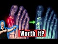 Is Bunion Surgery Worth It? [Big Toe Joint Arthritis]