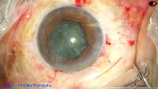 Small pupil Phaco under Topical and Patient unable to cooperate well - P Mohanta, 6th January, 2025