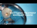 Root Canal Treatment on Maxillary Canine (Tooth 23)