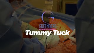 Tummy Tuck Surgery by Dr. Stephen Greenberg