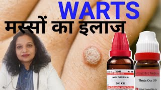 Warts || मस्सों का इलाज || Best Homeopathic Treatment of Warts