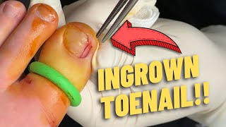 OFFICE SURGERY : Removing an ingrown toenail!