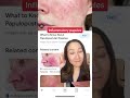 if you have rosacea u0026 skin redness watch this