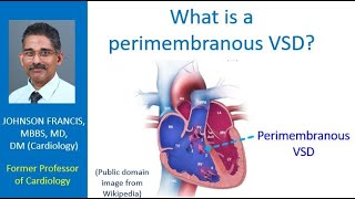What is a perimembranous VSD?