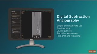 فیلم انیمیشن محلول فلوروسکوپی آنژیوگرافی دیجیتال تفریق فیلیپس (DSA).