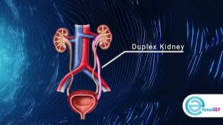 Duplex kidney.