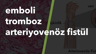 Arteriyovenöz fistül, Emboli, Tromboz #21