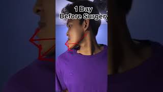 Jaw Surgery + Braces Explained 😬 Underbite With Anterior Open Bite