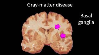 Neurometabolic disorders 2024