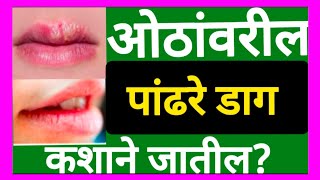 #bhais sir bhajan kirtan piliv#ओठावरील पांढरे डाग #भैस सर पिलिव #भिसे सर भजन #white patches on lips