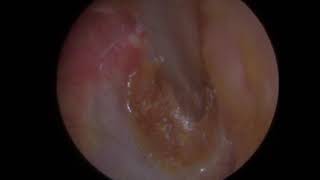 MISSION IMPOSSIBLE EAR WAX REMOVAL ! - #345