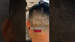 FUE Hair Transplant Scar COVER-UP #scalpmicropigmentation #hairloss #hairtattoo #scar #scarskin