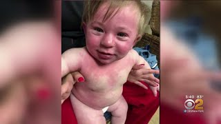 Child Has Anaphylactic Reaction To Paint With Dairy-Based Ingredients