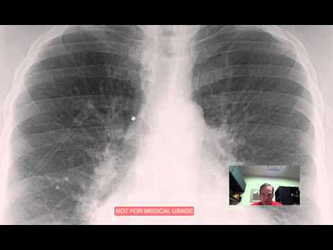 What is pulmonary plethora?