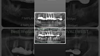 All Teeth in 72 hours | Best Fastest Implant Replacement Teeth • 9664988588 #implant  #dentalshorts