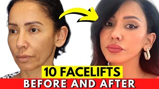 10 DRAMATIC yet Natural Facelifts! Miraculous!