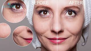 AntiAging Hyaluronic Acid Skin Injection Getting Profhilo in Singapore
