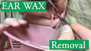 THICK EAR WAX PLUG REMOVED WITH FORCEPS - WAXVENT 14