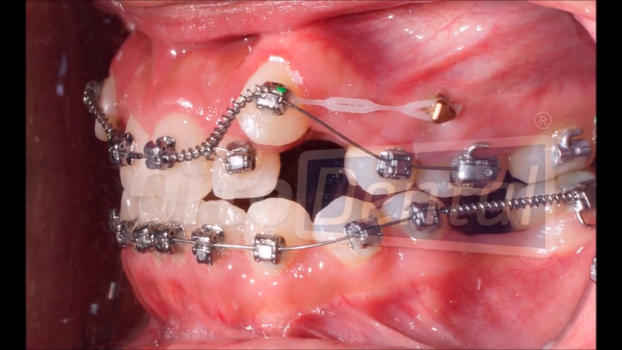 Colocación De Mini Implante Interradicular Ortodoncia | OrtoDental ...