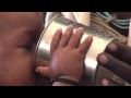 UNICEF and the European Union combat malnutrition in drought-stricken Uganda