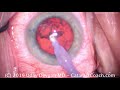 various approaches to removing the epi nucleus in cataract surgery