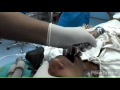 tracheal intubation technique