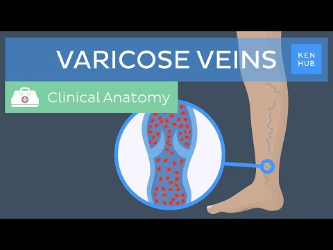 How do you describe varicose veins?