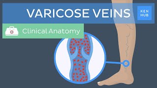 Varicose veins: Definition, causes, symptoms and treatment | Kenhub