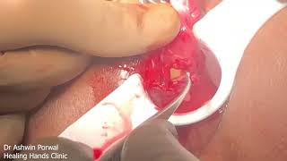Anal Sphincter Repair | DLPL | Recurrent Anterior Anal Fistula Surgery In Female | India | Dr Porwal