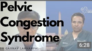 Doctors Guide To Understanding Pelvic Congestion Syndrome