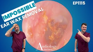 EXTREME Ear Wax Removal! Rock Hard Plug Stuck Deep 👂😱 - EP1115