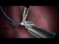 Lightpoint Medical robotic probe SENSEI®.