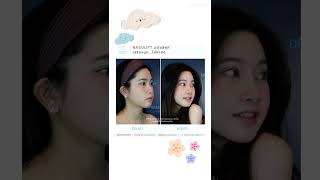 NASOLIFT (นาโซลิฟท์) เสริมจมูกไม่ผ่าตัด นวัตกรรมจากประเทศญี่ปุ่น by dr.cherrybeauty clinic