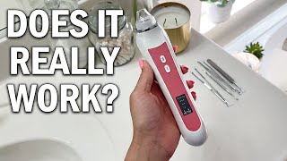 Blackhead Remover Vacuum Review - Does It Really Work?