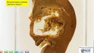 Liver: Amoebic abscess gross pathology