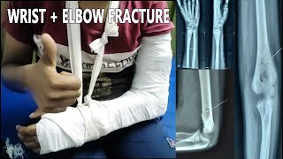 BANGALORE PUTTUR KATTU |2 FRACTURES  IN 1 HAND | WRIST \u0026 ELBOW FRACTURE |  ANEKAL PUTTUR KATTU