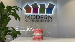 What are Elastics (Rubber bands) in Orthodontics?