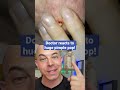 Doctor reacts to huge pimple pop!💥