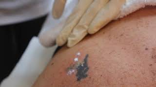 Laser Tattoo removal with Q-Switched Nd:YAG