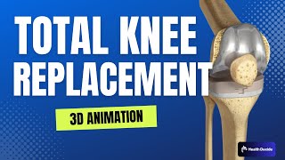 Total Knee Replacement (TKR): Condition, Treatment, and Surgery - 3D Animation