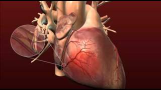 Heart Health - Coronary Artery Disease and Coronary Bypass Surgery with Dr. Brian Foy