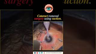 Cataract Surgery Simplified: How Suction Restores Clear Vision in Minutes!